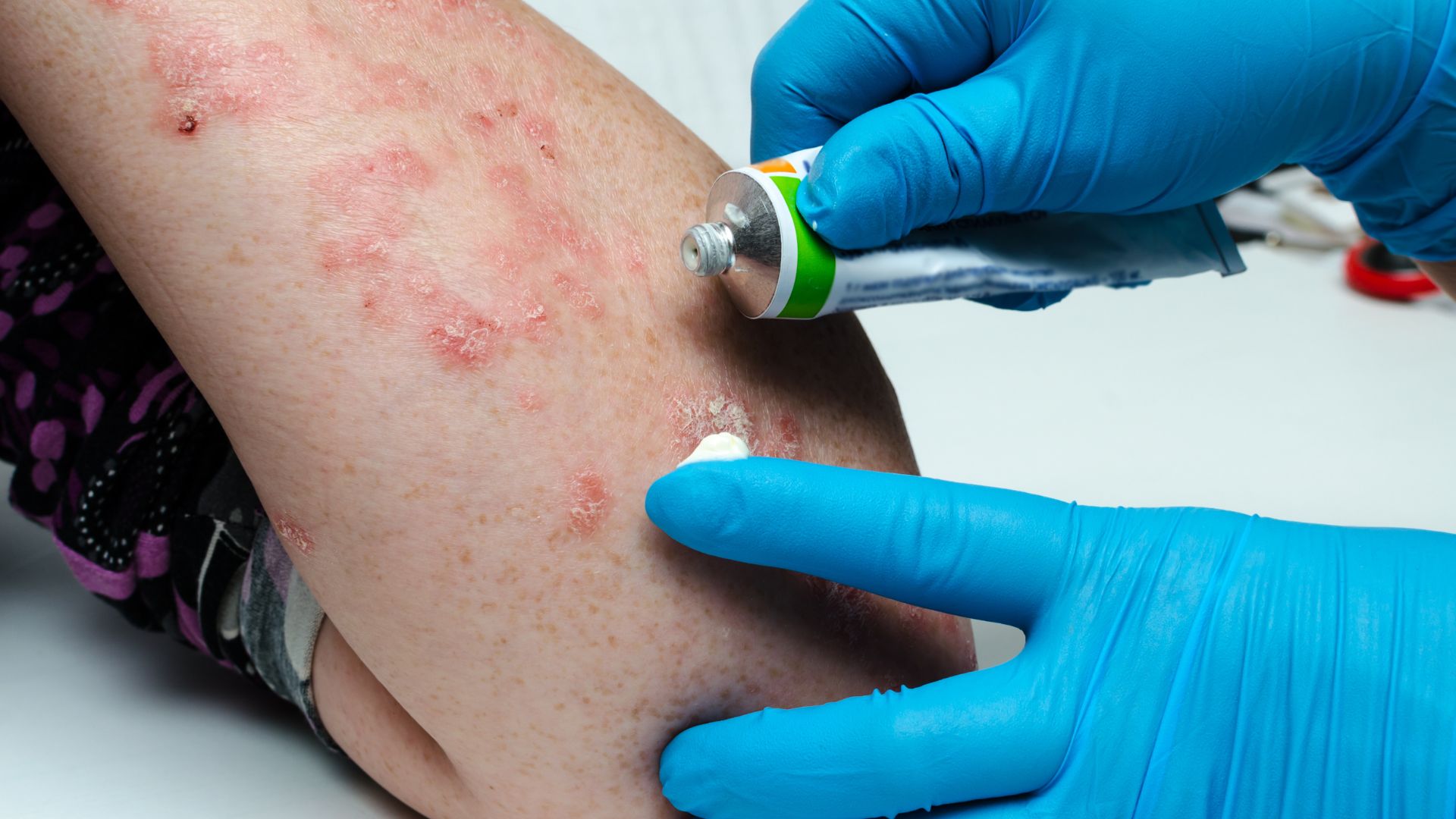 Psoriatrická artritída Príčiny vzniku, príznaky a možnosti liečbyb
